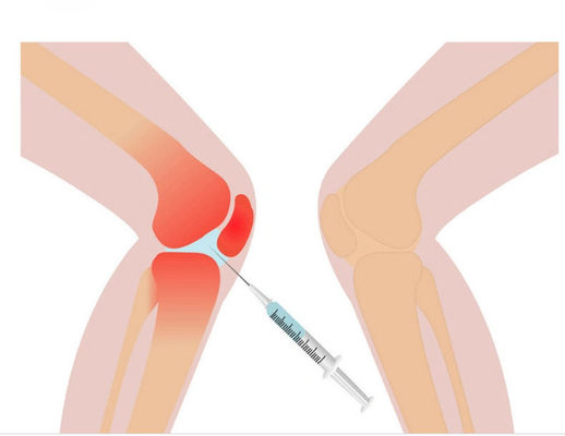 3ml 무릎 통증 Mesotherapy 솔루션 비 가교 히알루론산