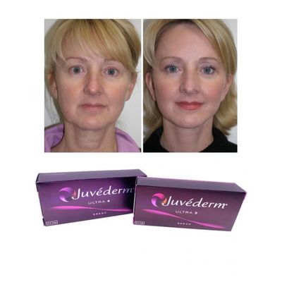 6~9개월 지속 Juvederm 피부 필러 젤 온라인 및 매장 구매