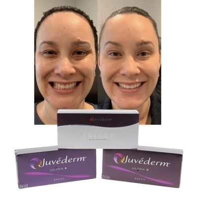 Juvederm 피부 립 필러 히알루론산 교차 연계 주입