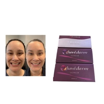 Juvederm 주사용 피부 필러 Juvederm Ultra3