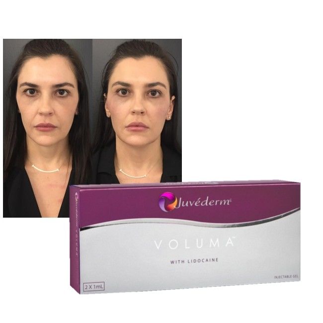 히알루론산 피부 필러 젤 Juvederm 입술 뺨 회춘 강화 포뮬러
