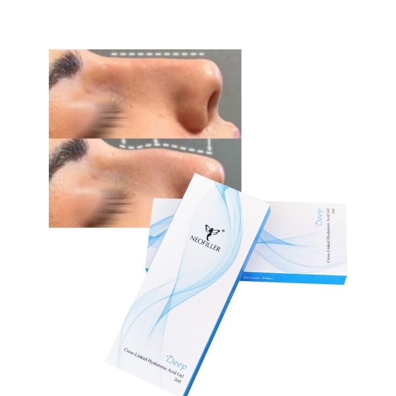 교차 연결된 2ml 히알루론산 피부 필러 딥 라인 코 윤곽선 주사 가능한 젤 얼굴 향상