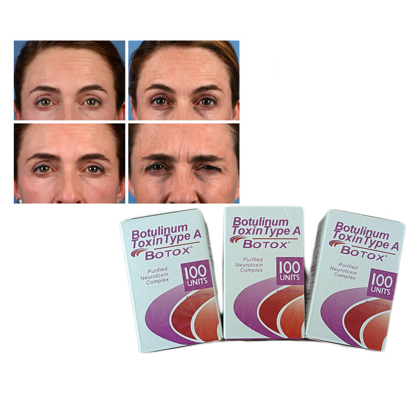 100U/포자 A형 보툴리넘 독성물질 구부러기 방지 보톡스 분말